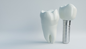 Side-by-side comparison of tooth and dental implants