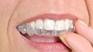 close up of person placing clear aligner over their teeth