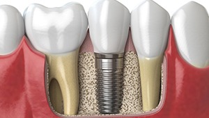diagram of dental implant