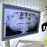 Dental x-rays on computer