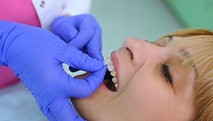 Woman getting a veneer placed on a tooth